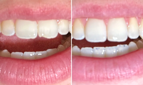 Resin Bonding