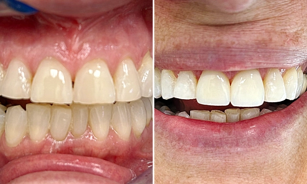 Veneer