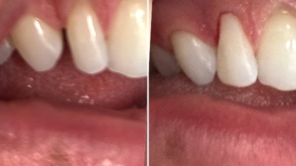 Resin Bonding